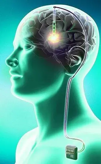 Parkinson Disease